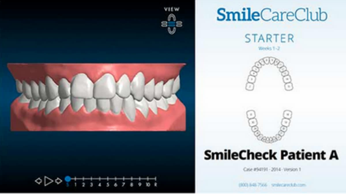Example of crowded teeth before treatment