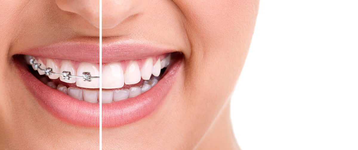A healthy smile with braces