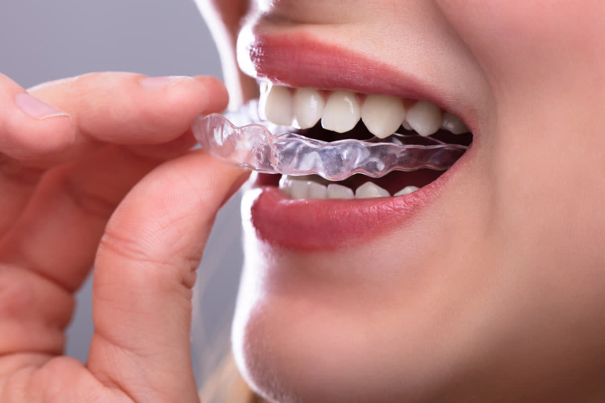 A hand fitting a clear aligner over teeth