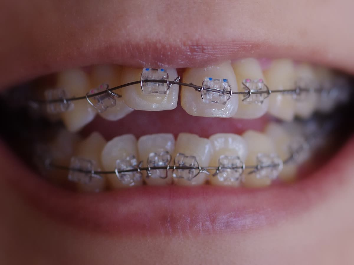 Close-up of teeth with orthodontic work